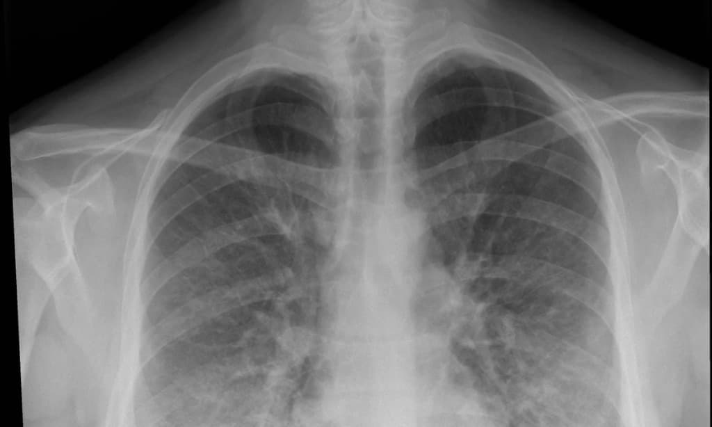 Pneumonia and chest infection care