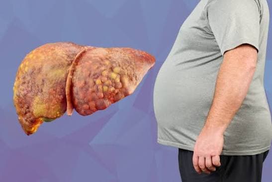 Fatty liver disease management